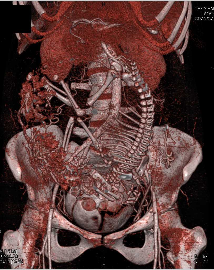 Perfusion Changes in the Fetus in a Patient Post Trauma - CTisus CT Scan