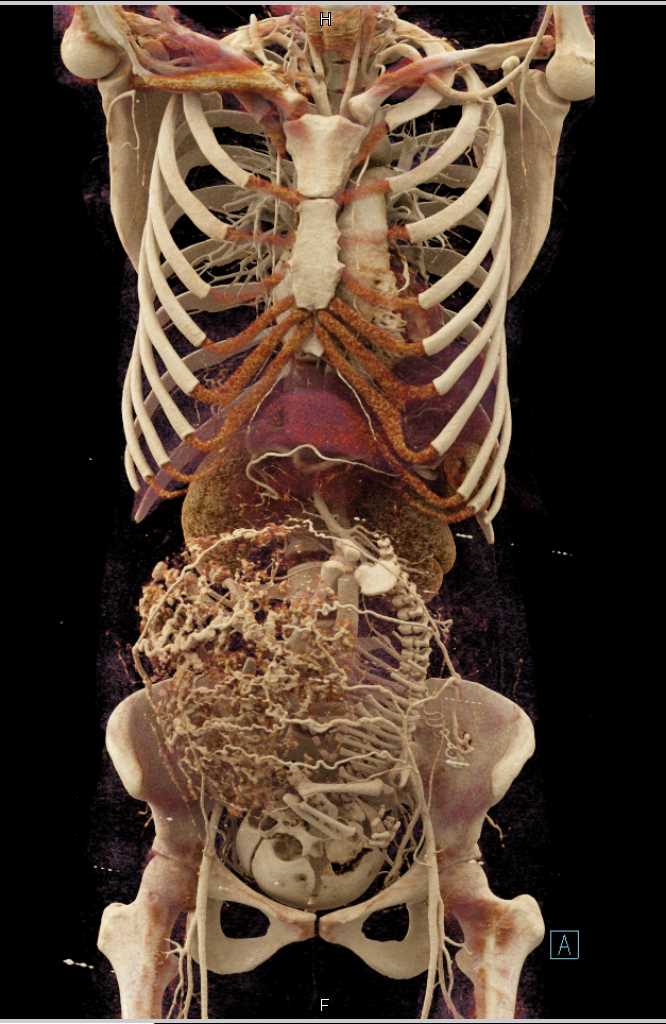 Pregnancy with Vascular Placenta - CTisus CT Scan