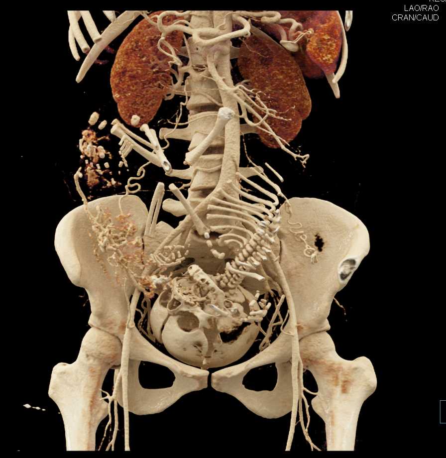 Pregnancy with Vascular Placenta - CTisus CT Scan
