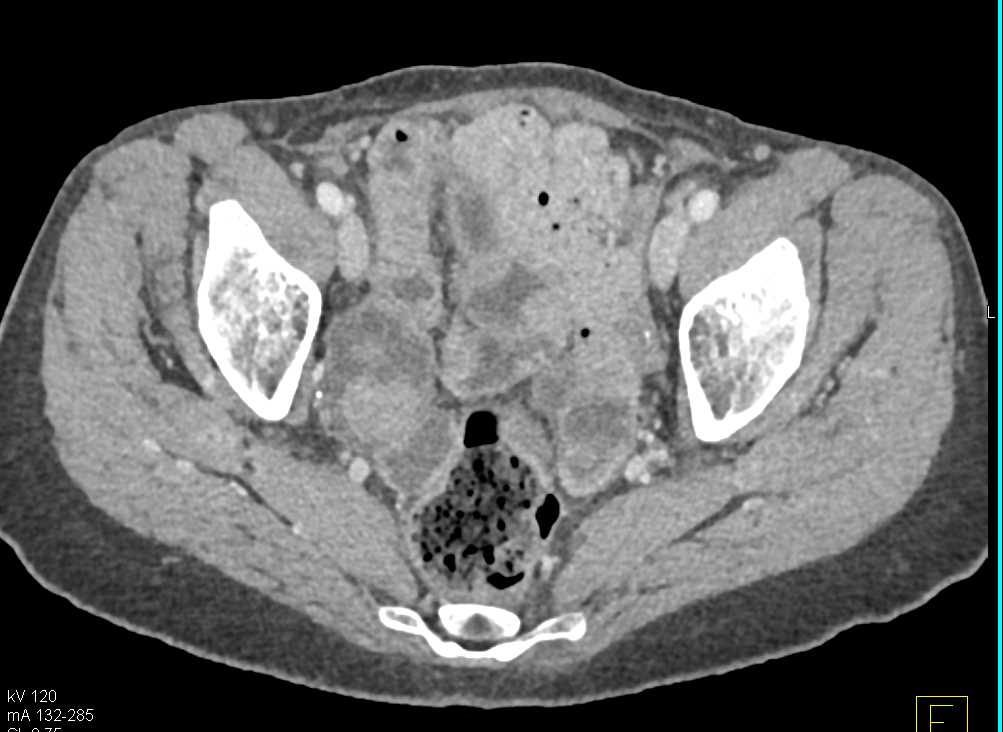 Bilateral Ovarian Metastases - CTisus CT Scan