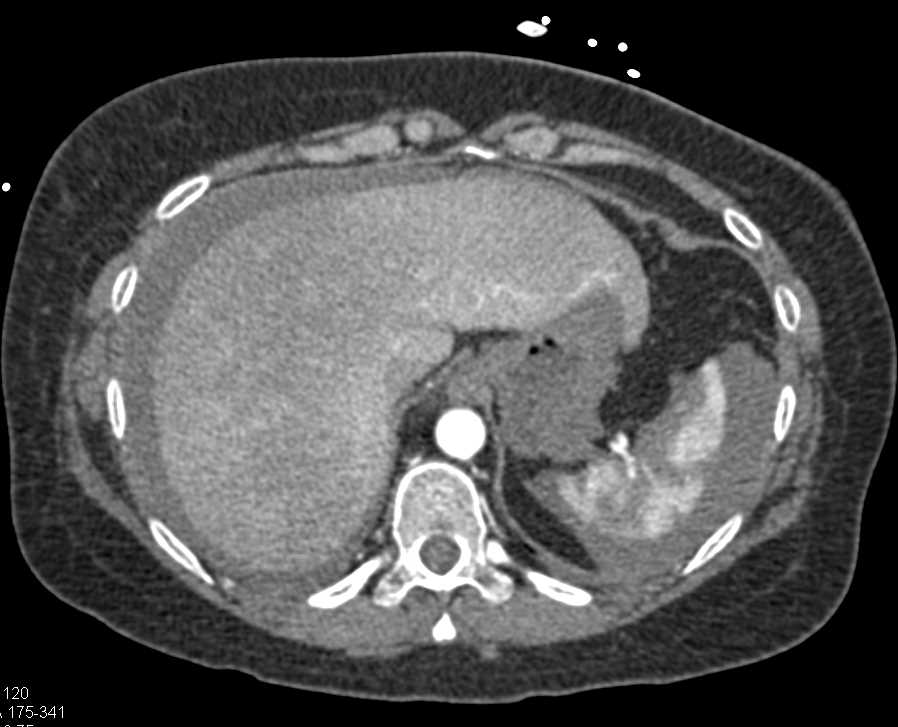Carcinomatosis with Metastases to the Ovaries - CTisus CT Scan