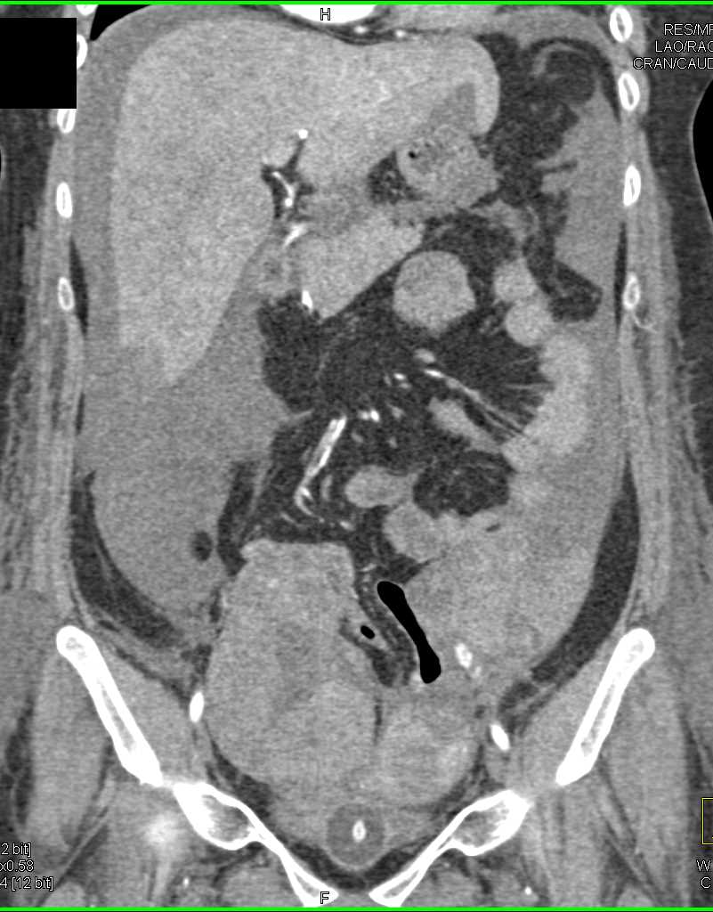 Carcinomatosis with Metastases to the Ovaries - CTisus CT Scan
