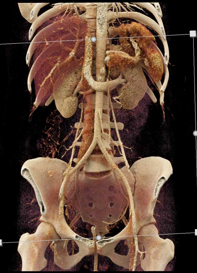 Post Partum Bleed - CTisus CT Scan