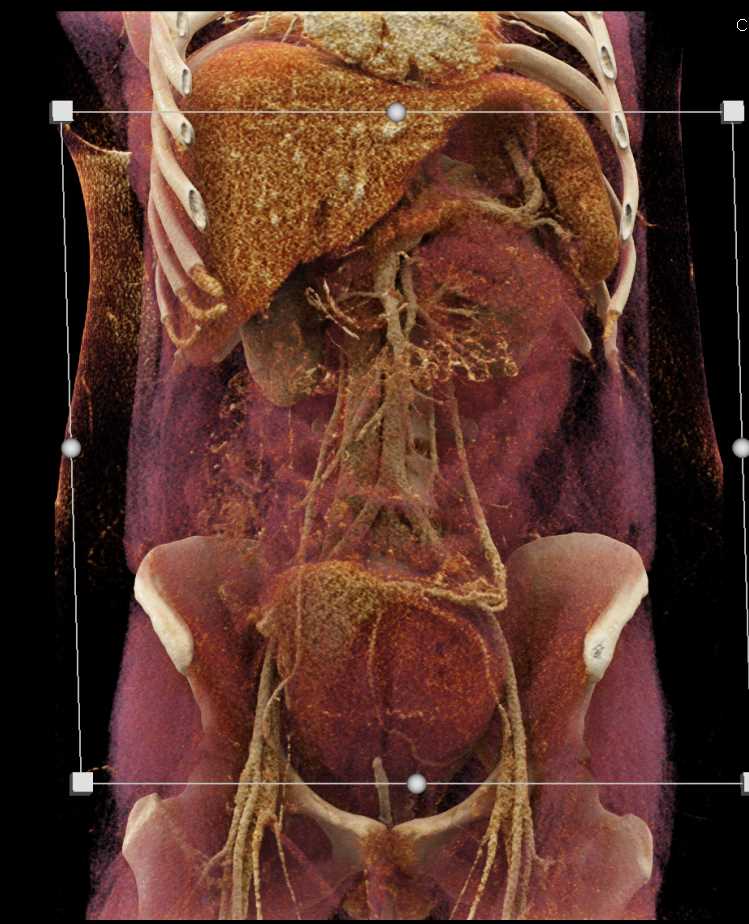 Post Partum Bleed - CTisus CT Scan