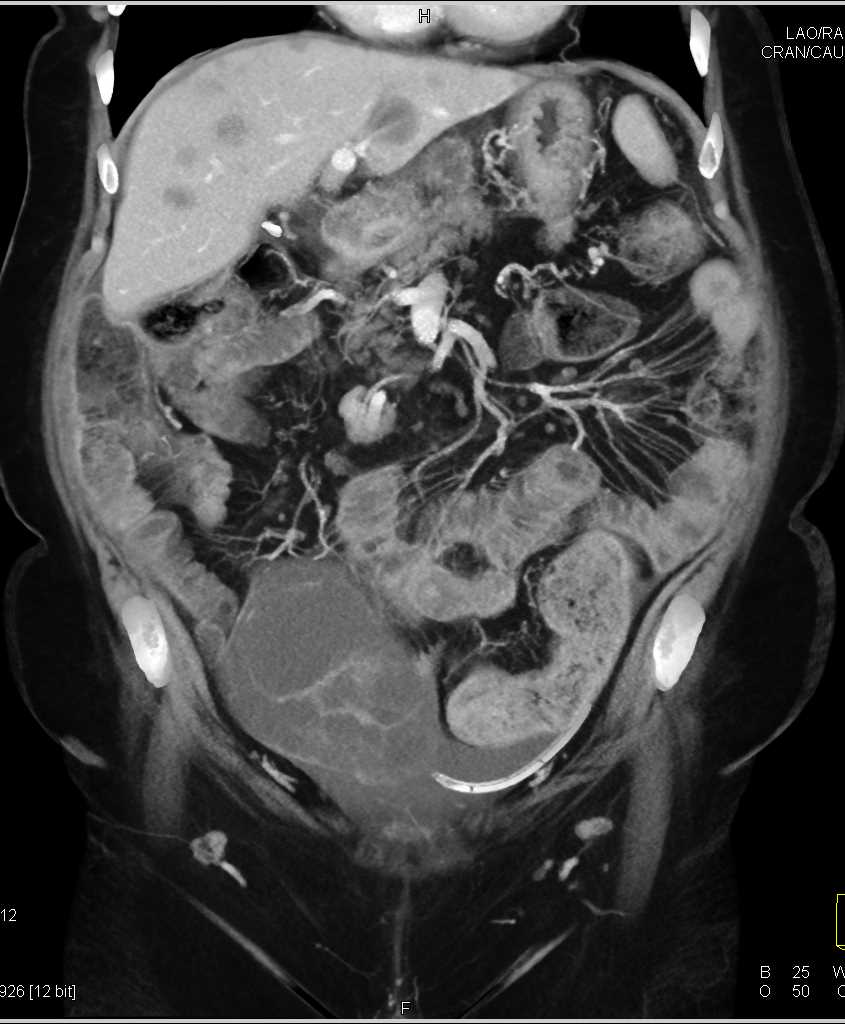 Ovarian Cancer with Carcinomatosis - CTisus CT Scan