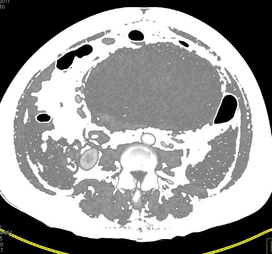 Ovarian Carcinoma - CTisus CT Scan