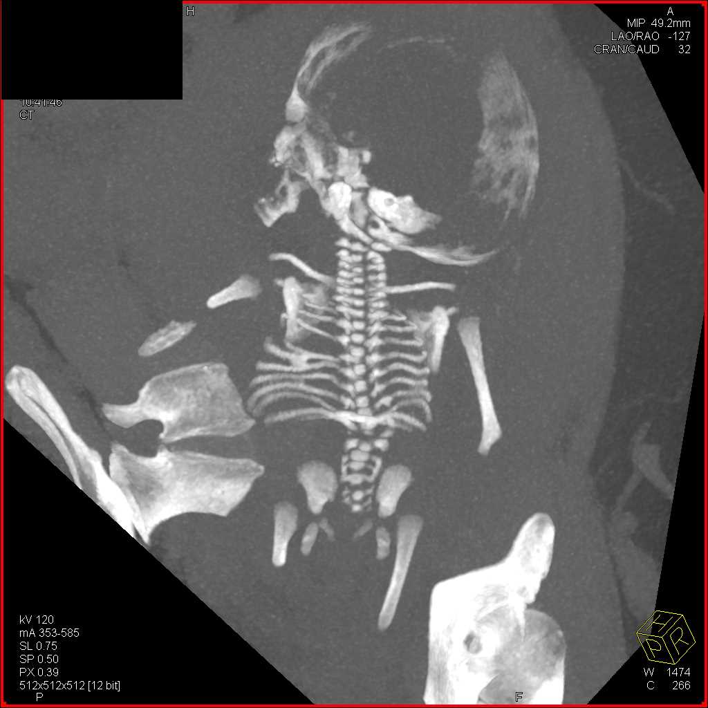CT Fetus with Skeletal Dysplasia - CTisus CT Scan