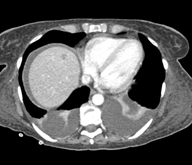 Ovarian Cancer with Carcinomatosis - CTisus CT Scan