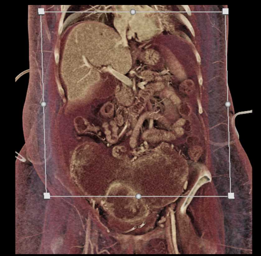 Ovarian Cancer with Carcinomatosis - CTisus CT Scan