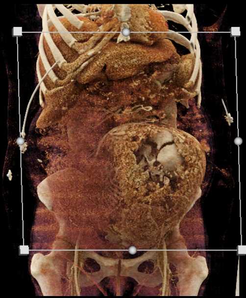 Rectus Sheath Hematoma in a Pregnant Patient - CTisus CT Scan
