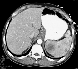 Lymphoma - CTisus CT Scan