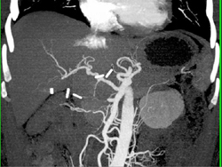 Replaced Right Hepatic Artery - CTisus CT Scan