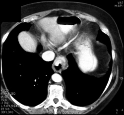 Hiatal Hernia - CTisus CT Scan