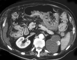 Partial Portal Vein Thrombosis - CTisus CT Scan