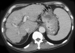 Metastatic Renal Cell Carcinoma - CTisus CT Scan