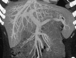 Normal Portal Vein - CTisus CT Scan