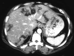 Liver Infarcts - CTisus CT Scan