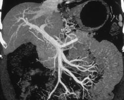 Normal Mesenteric Vessels - CTisus CT Scan