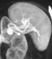 Splenic Artery Aneurysm - CTisus CT Scan