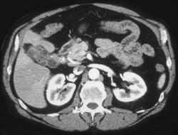 Gallbladder Cancer - CTisus CT Scan