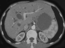 Dilated Intrahepatic Ducts - CTisus CT Scan