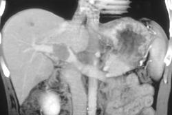 Clot in Portal Vein - CTisus CT Scan