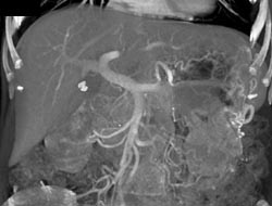 Splenic Vein Occlusion With Collaterals - CTisus CT Scan