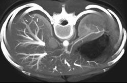 Hepatic Venous Anatomy - CTisus CT Scan