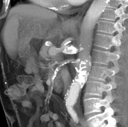 Celiac Artery Aneurysm - CTisus CT Scan