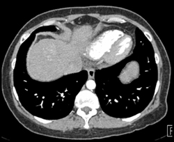 Portal Hypertension - CTisus CT Scan