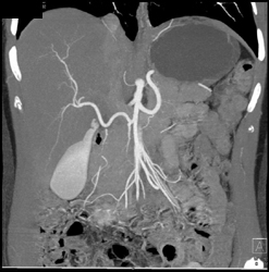 Replaced Hepatic Artery Off SMA - CTisus CT Scan