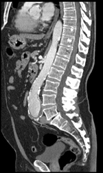 Stenosis of Celiac Artery - CTisus CT Scan