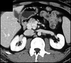 Cavernous Transformation of the Portal Vein (CTPV) - CTisus CT Scan