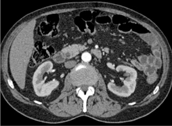 Stone in Distal Common Bile Duct (CBD) - CTisus CT Scan