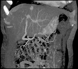 Focal Nodular Hyperplasia (FNH) Liver - CTisus CT Scan