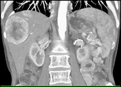 Islet Cell Tumor of the Pancreas With Liver Metastases - CTisus CT Scan