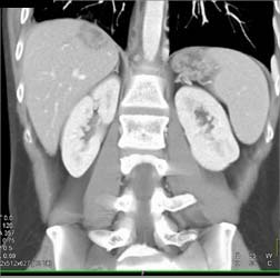 Neuroendocrine Tumor - CTisus CT Scan