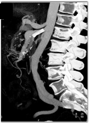 SMA Aneurysm With Stent - CTisus CT Scan