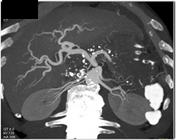 Cirrhosis and Chronic Pancreatitis - CTisus CT Scan