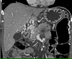 Cavernous Transformation of the Portal Vein (CTPV) Due to Pancreatic Cancer - CTisus CT Scan