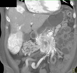 Islet Cell Tumor With Vascular Liver Metastases - CTisus CT Scan