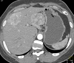 Islet Cell With Liver Metastases - CTisus CT Scan