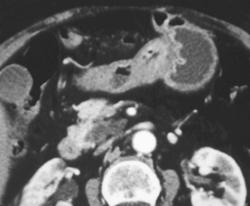 Adenocarcinoma - CTisus CT Scan