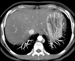 Gastrinoma - CTisus CT Scan