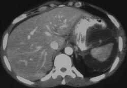 Pseudocyst Compresses Stomach and Spleen - CTisus CT Scan