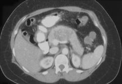 Cystadenocarcinoma of the Pancreas - CTisus CT Scan