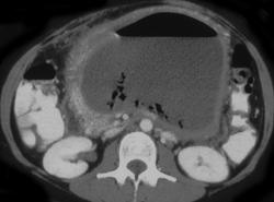 Pancreatic Abscess - Pancreas Case Studies - CTisus CT Scanning