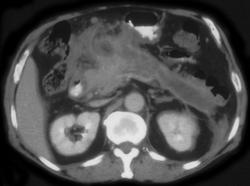 Svm Thrombosis Due to Pancreatitis - CTisus CT Scan