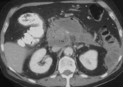 Pancreatic Abscess - CTisus CT Scan