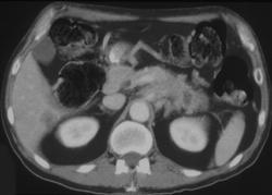 Carcinoma of the Tail of the Pancreas - CTisus CT Scan